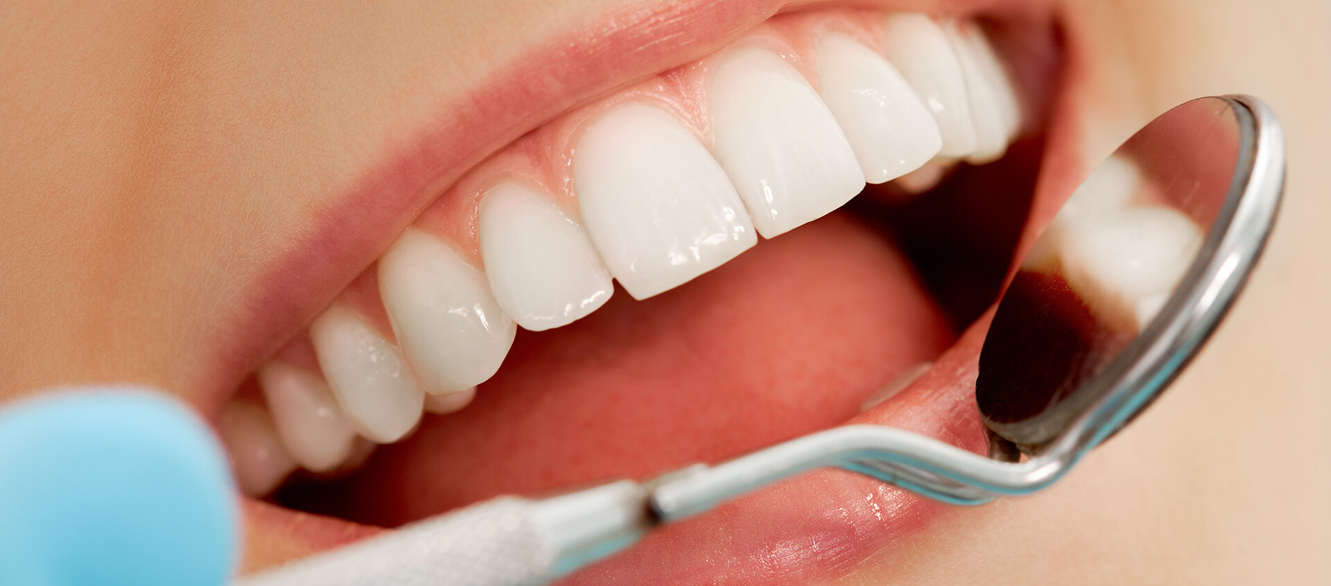 Stained Teeth Solution From Teeth Whitening Dentist in Brandon FL Area