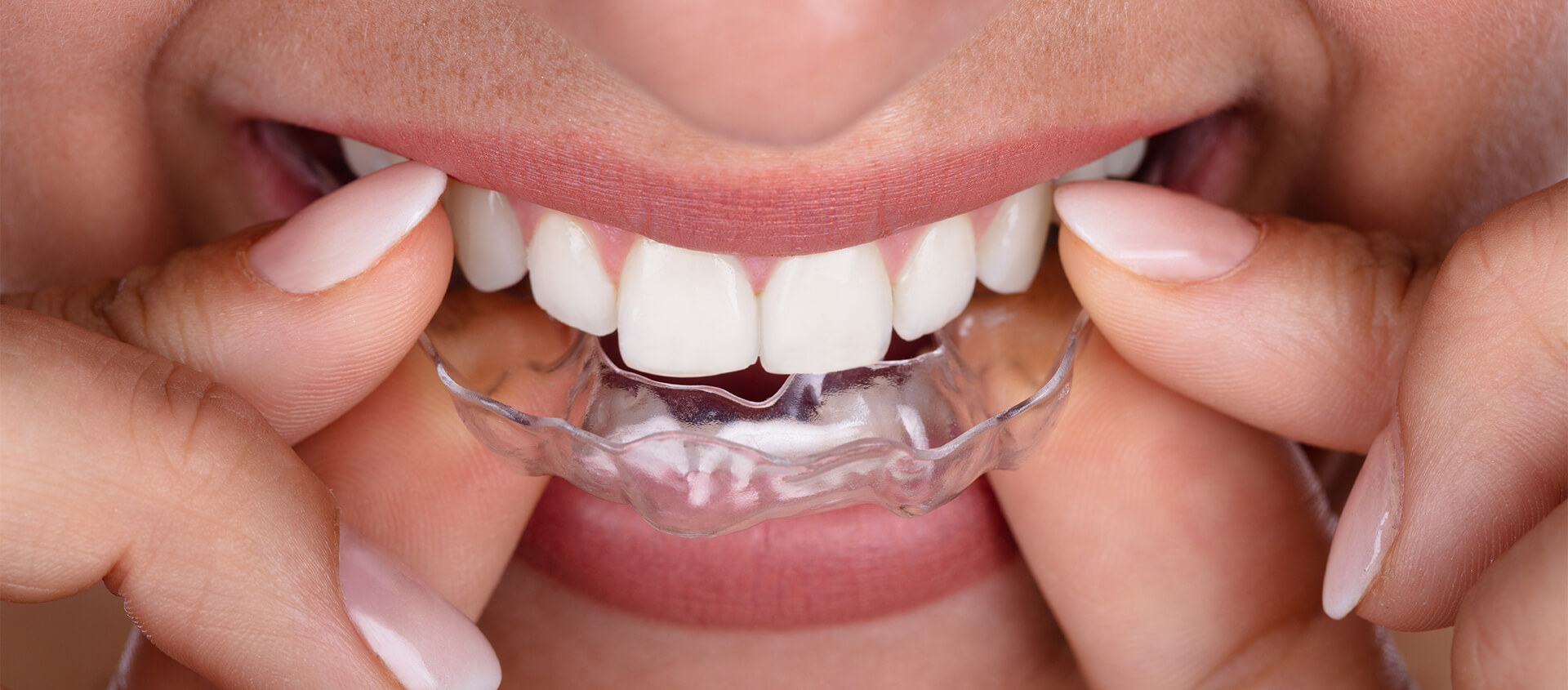 Orthodontics / Invisible / Clear Braces - Dr. Shukla's Dent Care